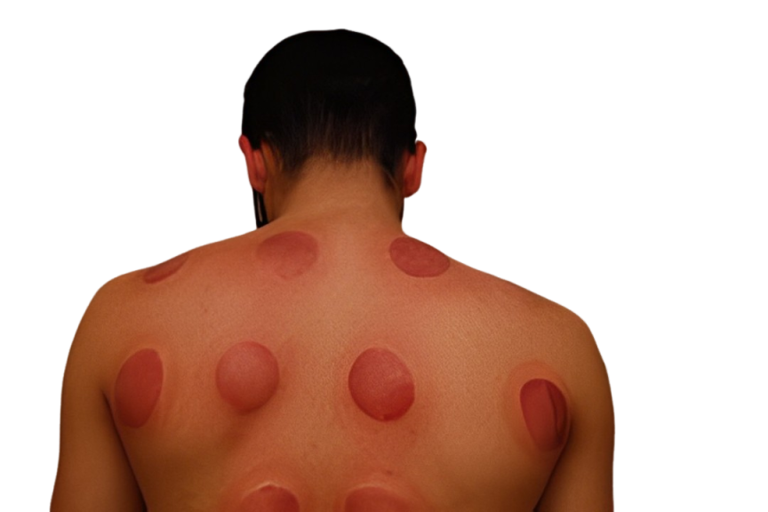 Kesan Selepas Berbekam: Manfaat dan Tanda 16